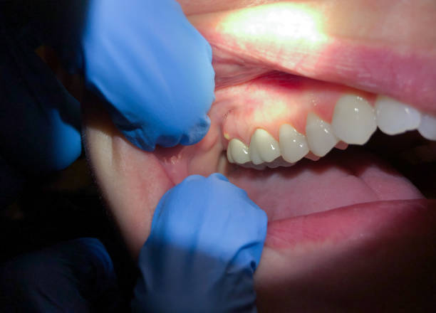 Best Dental Abscess Treatment in Bellevue, PA